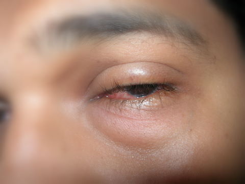 Itchy Rash Around Eyes And Eyelids - HealthTap